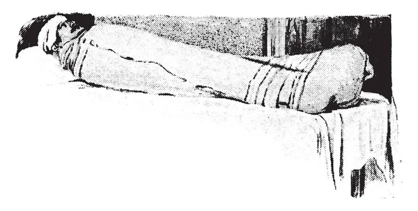 Pacote de manta, paciente parcialmente envolto, gravura vintage . — Vetor de Stock