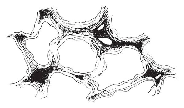 Розділ Легенів Показуючи Інфільтрації Сполучної Тканини Альвеолярного Стіни Вугільного Пилу — стоковий вектор