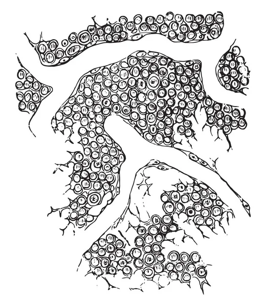 Круглые Клетки Саркомы Винтажные Гравированные Иллюстрации — стоковый вектор