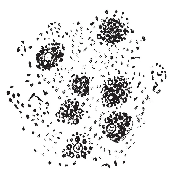 Degeneración grasa de las células hepáticas, grabado vintage . — Archivo Imágenes Vectoriales