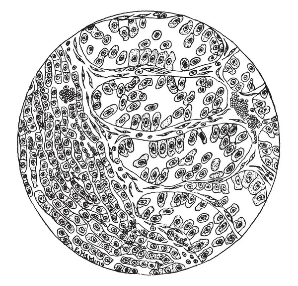 Розділ Карциноми Печінки Вінтажні Гравіровані Ілюстрації — стоковий вектор