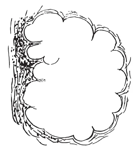 Enfisema pulmonar, grabado vintage . — Archivo Imágenes Vectoriales