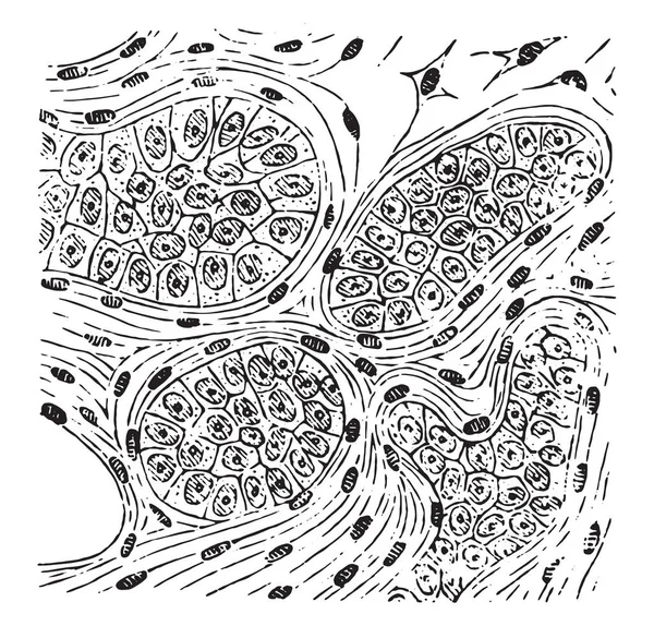 Encephaloid 复古雕刻插图 — 图库矢量图片