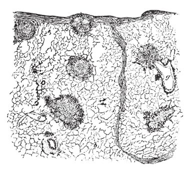 Akciğer chalicosis, vintage oyulmuş resimde gösterilen bölümünü