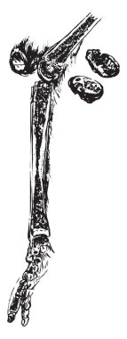 Tibia, içeren osteomiyelit vintage oyma.