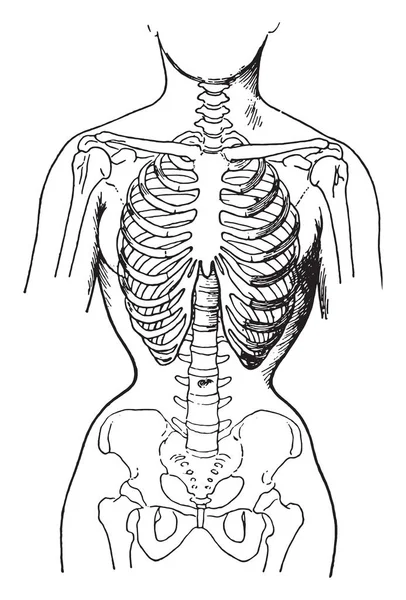 Deformed by the corsets, showing condition of bones in women who — Stock Vector