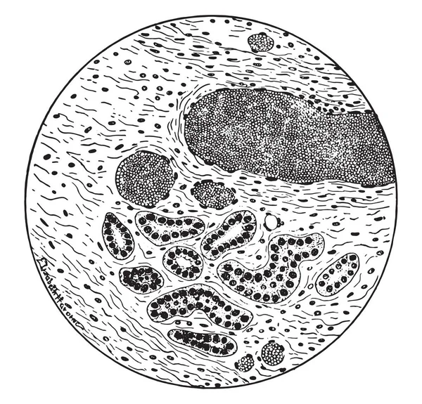 Aangeboren cystic ziekte van de nieren, vintage gravure. — Stockvector