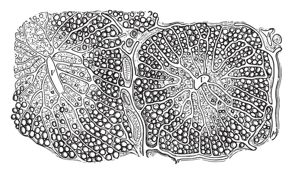脂肪浸润肝脏 复古雕刻插图 — 图库矢量图片