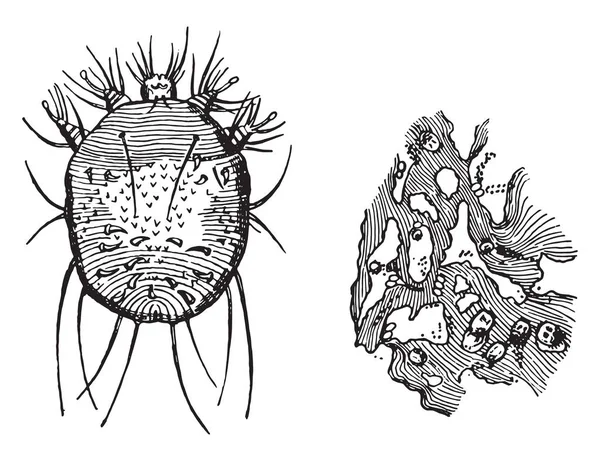 Acarus Scabiei Portion Epidermis Showing Burrows Contained Eggs Vintage Engraved — Stock Vector