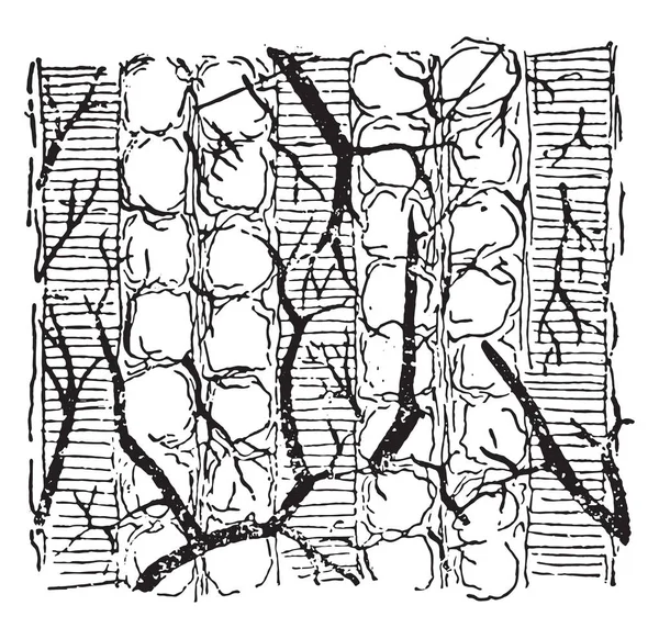 Paralisia Muscular Pseudohipertrófica Infiltração Gordurosa Músculo Ilustração Gravada Vintage — Vetor de Stock