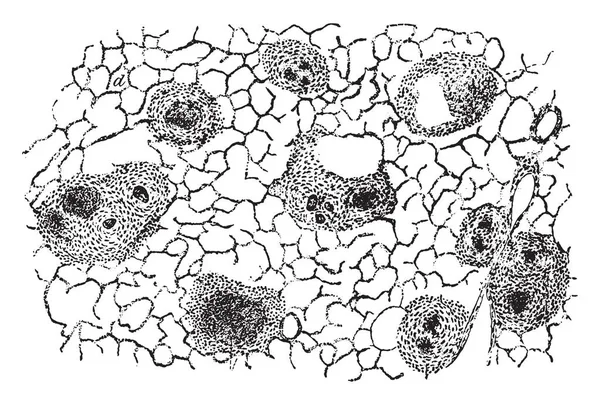 肺部急性播散性肺结核 复古雕刻插图 — 图库矢量图片