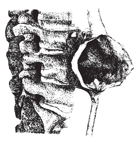 Aneurisma simétrico da aorta abdominal, gravura vintage . — Vetor de Stock