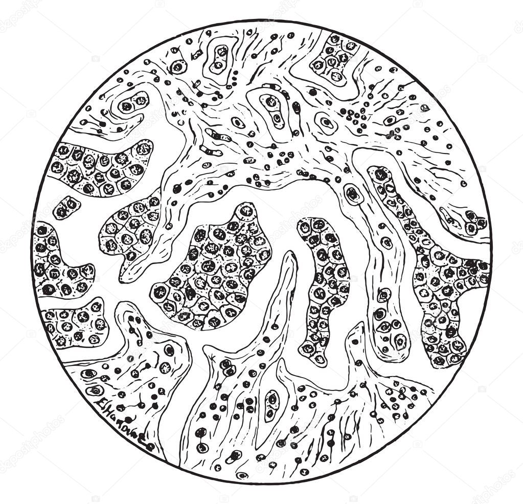 Glandular carcinoma of the liver, vintage engraved illustration