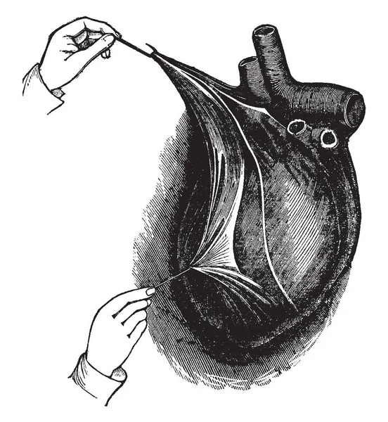 Dit Diagram Vertegenwoordigt Hart Ingesloten Haar Tas Pericard Die Ernstige — Stockvector