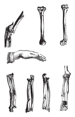 Bu resimde kemik kırıkları, vintage çizgi çizme veya oyma illüstrasyon temsil eder..