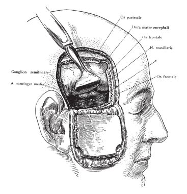 Exposure of the Gasserian ganglion and middle meningeal artery though a flap incision of the scalp and skull, vintage line drawing or engraving illustration. clipart