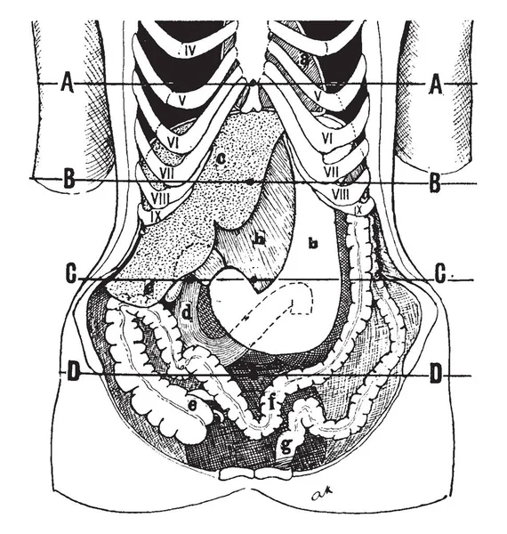 Visceroptosis Vintage Çizgi Çizme Veya Oyma Illüstrasyon Durumda Organlar Konumunu — Stok Vektör