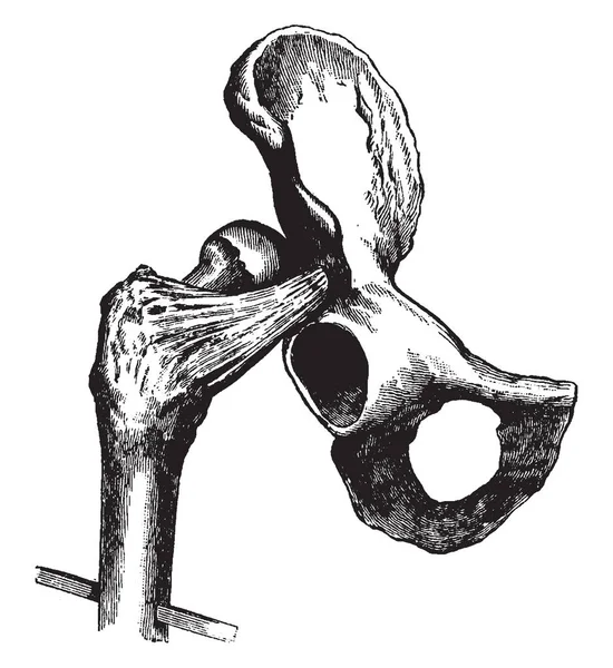 Esta Ilustración Representa Dislocación Cadera Sobre Dorsum Illi Dibujo Línea — Archivo Imágenes Vectoriales