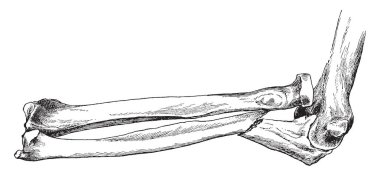 Bu resimde RADIUS yerinden çıkması, vintage çizgi çizme veya oyma illüstrasyon ile kırık Dirsek kemiği temsil eder..