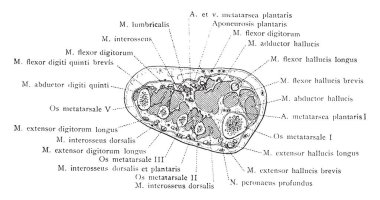 Bu resimde kesit aracılığıyla Tarso Metatarsal ortak, ayak, vintage çizgi çizme veya oyma illüstrasyon temsil eder..