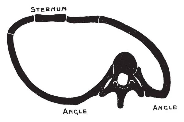 Deze Afbeelding Vertegenwoordigt Veranderingen Thorax Scoliose Van Wervelkolom Vintage Lijntekening — Stockvector