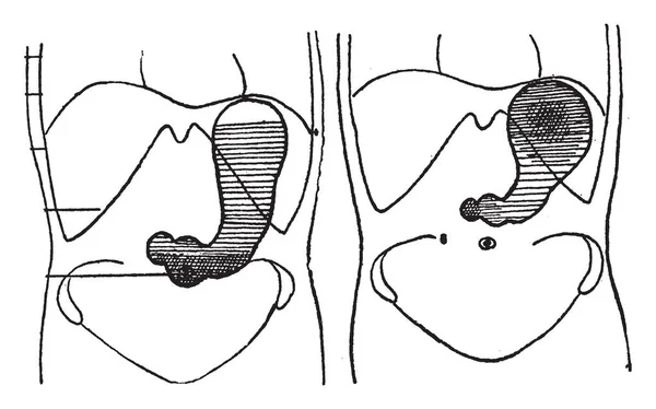 Ilustrasi Ini Menggambarkan Stomach Dalam Diet Bismuth Laden Gambar Garis - Stok Vektor