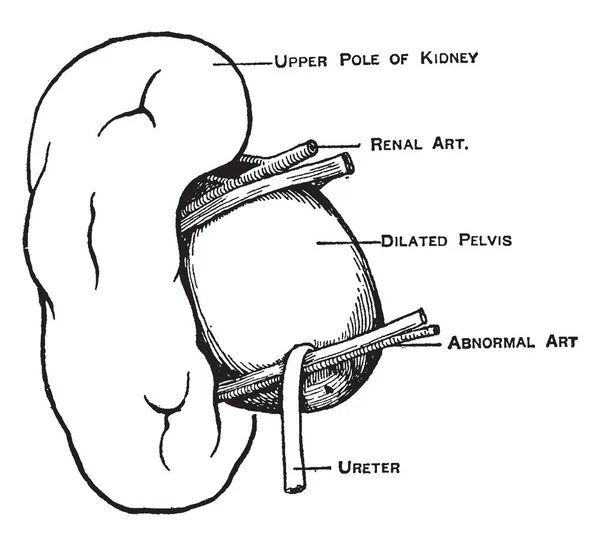 Esta Ilustración Representa Arteria Renal Anormal Dibujo Línea Vintage Ilustración — Archivo Imágenes Vectoriales