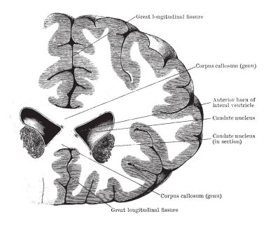 Koronal bölümü frontal lob ve lateral ventrikül, vintage çizgi çizme veya oyma illüstrasyon ön boynuzları üzerinden.