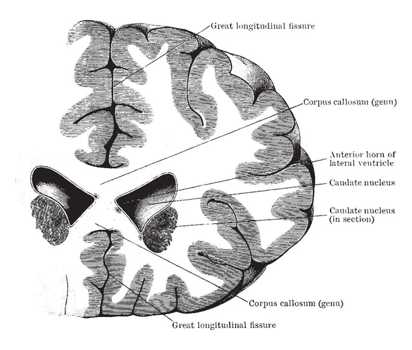 Koronal bölümü frontal lob ve lateral ventrikül, vintage çizgi çizme veya oyma illüstrasyon ön boynuzları üzerinden.