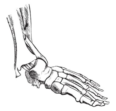 Bu resimde kırık Fibula, vintage çizgi çizme veya oyma illüstrasyon temsil eder..
