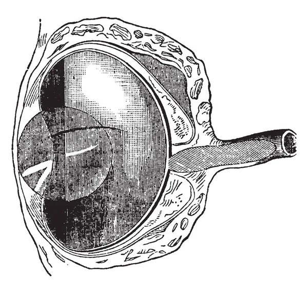 Fish Eye Anterior Posterior Diameter Has Been Decreased Vintage Line — Stock Vector