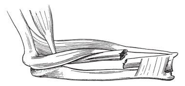 Ne zaman bir kemik kan trickles yaralı parçaları, vintage çizgi çizme veya oyma illüstrasyon arasında patlak.