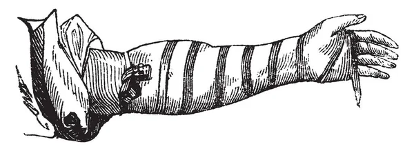 Een Ingepakte Arm Heeft Een Hand Beelden Vintage Lijntekening Gravure — Stockvector