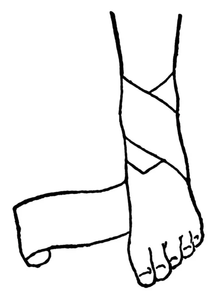 Ein Bein Das Einen Verband Den Knöchel Gewickelt Ist Vintage — Stockvektor