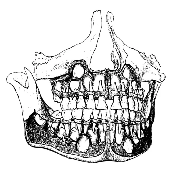 Diagram Baby Jaw Showing Both Temporary Permanent Teeth Vintage Line — Stock Vector