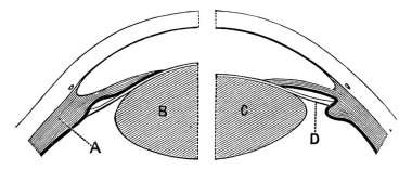 Sağ tarafta mercek uzak görüş için düzenlenir, silivri kas gevşetir, ve bağ dokusu gergin, 'D' sıkıştırmasıyla düzleşir lensin 'C' lensinin önünde, sol tarafta kas, 'A', vintage çizgi çizimi veya çizimi