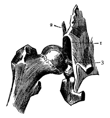 Kapsül bağları kesilmiş kalça eklemi, işaretli, '1, 2 ve 3', soketin marjı, kapsül bağının bir kısmı ve yuvarlak bağ dokusu, sırasıyla, klasik çizgi çizimi veya oyma çizimi.