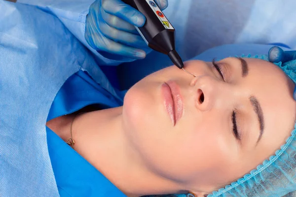Woman having a non surgical procedure to remove nasolabial wrinkles with a laser device by a cosmetologist in a medical clinic. Thread lift procedure. Patient with eyes closed having lifting procedure