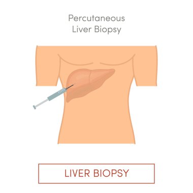 Percutaneous liver biopsy, simple vector illustration clipart