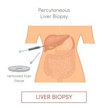 Percutaneous liver biopsy, simple vector illustration clipart