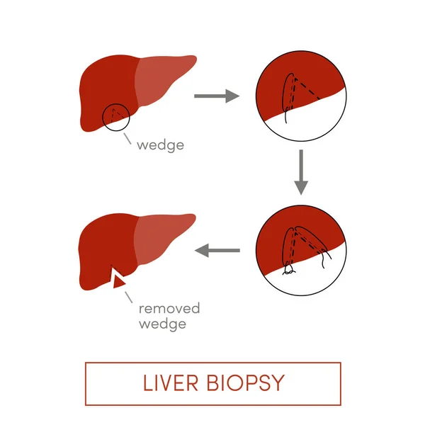 Biopsia Hepática Ilustración Vectorial Simple — Vector de stock