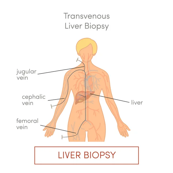 Types Biopsie Hépatique Transveineuse Illustration Vectorielle Plate — Image vectorielle