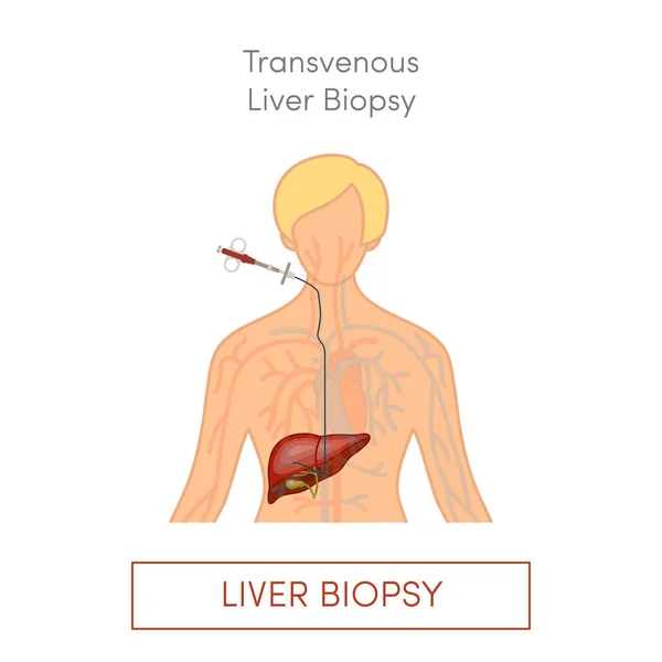 Biópsia Hepática Transvenosa Ilustração Vetorial Plana — Vetor de Stock