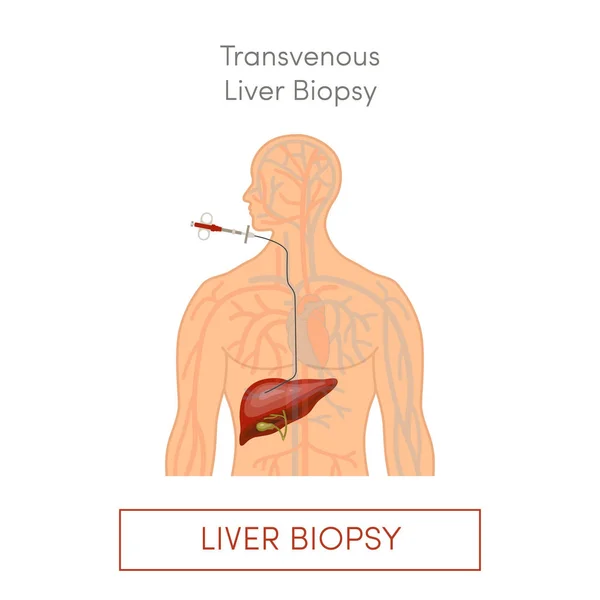 Biopsia Hepática Transvenosa Ilustración Vectorial Plana — Archivo Imágenes Vectoriales