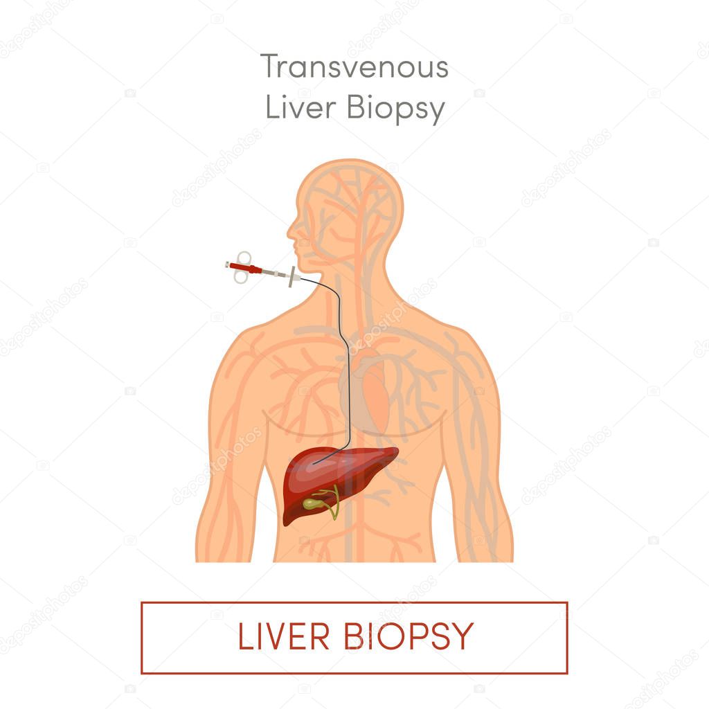 Transvenous liver biopsy, flat vector illustration