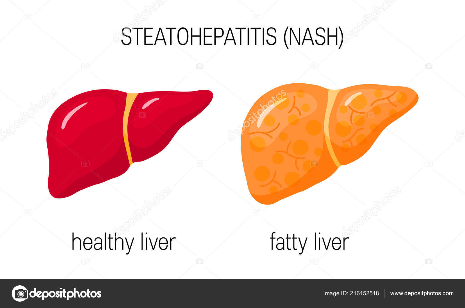 esteatohepatitis alcoholica