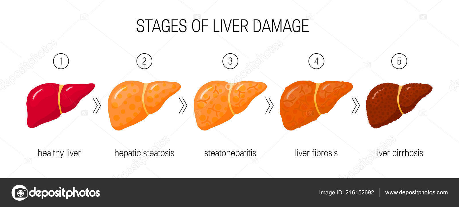 Stages Liver Damage Concept Vector Illustration Healthy Liver Steatosis  Nash Stock Vector Image by ©marina_ua #216152692