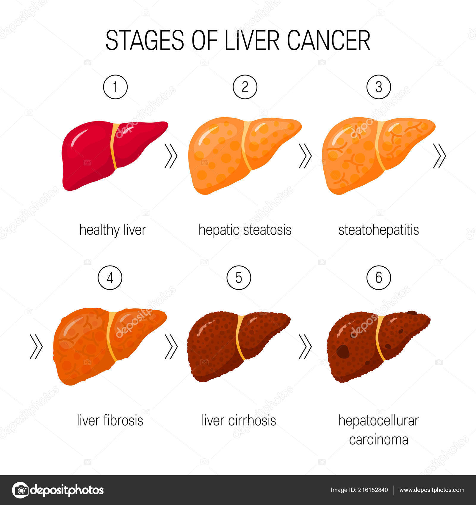 Stages Liver Damage Concept Vector Illustration Healthy Liver Steatosis Nash ⬇ Vector Image by