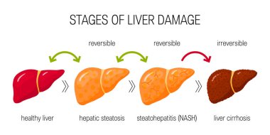 Stages of liver damage concept. Vector illustration of reversible and irreversible liver conditions in flat style clipart