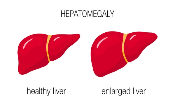 Hepatomegalie Koncept Vektorové Ilustrace Zdravého Zvětšená Játra Karikatuře Stylu — Stockový vektor